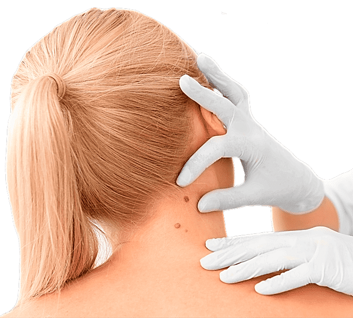 Удаление новообразований Surgitron (США)