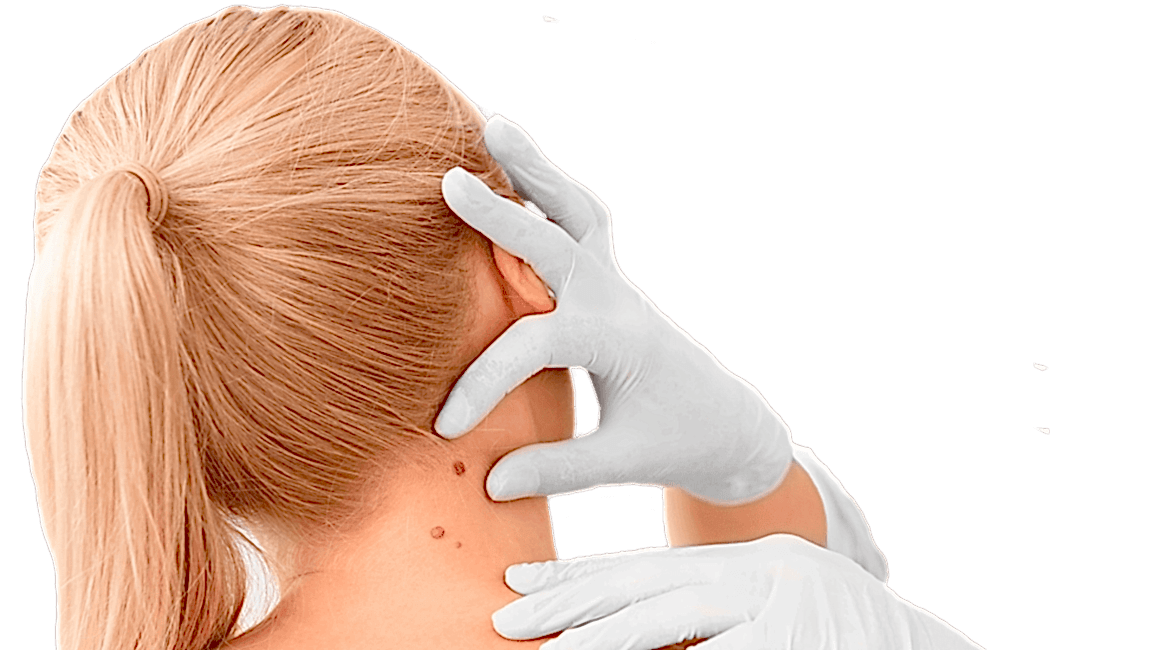 Удаление новообразований Surgitron (США)