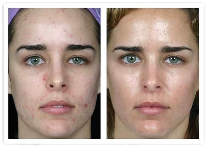 Фото чистки лица до и после 5