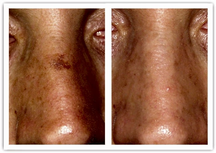 Лазерная шлифовка Laserplanet4-min.jpg