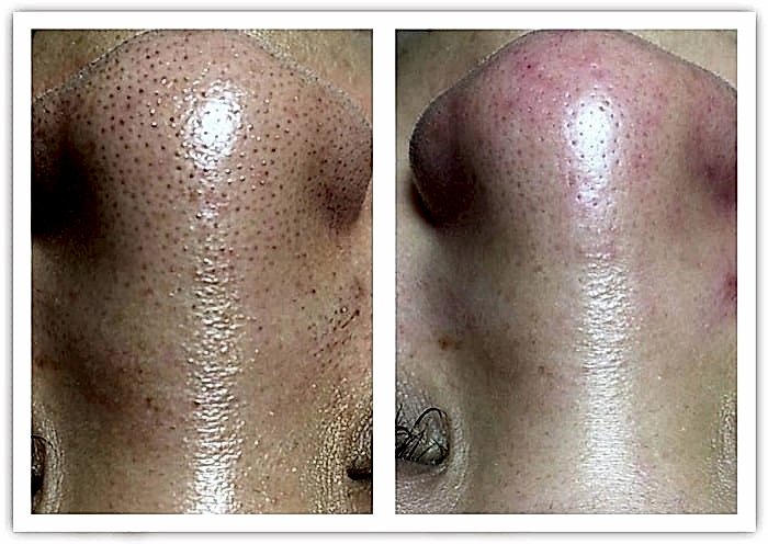 Фото чистки лица до и после 3