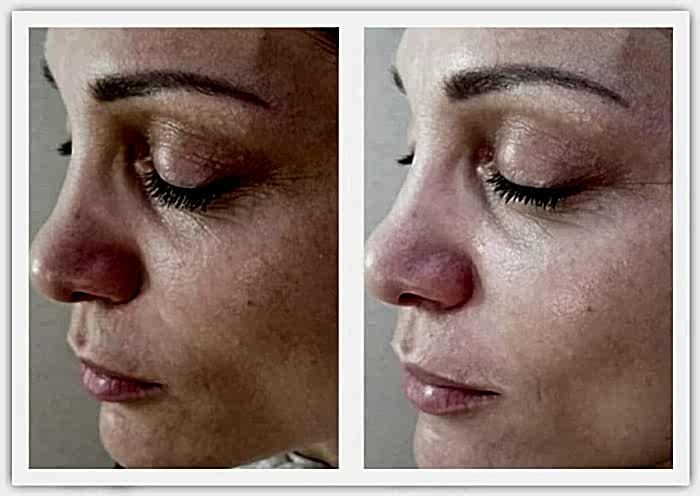 Фото чистки лица до и после 2