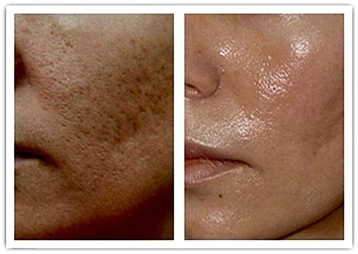 Лазерная шлифовка до после Laserplanet1-min.jpg