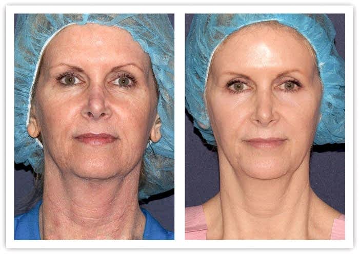 РФ лифтинг до и после Laserplanet2.jpg