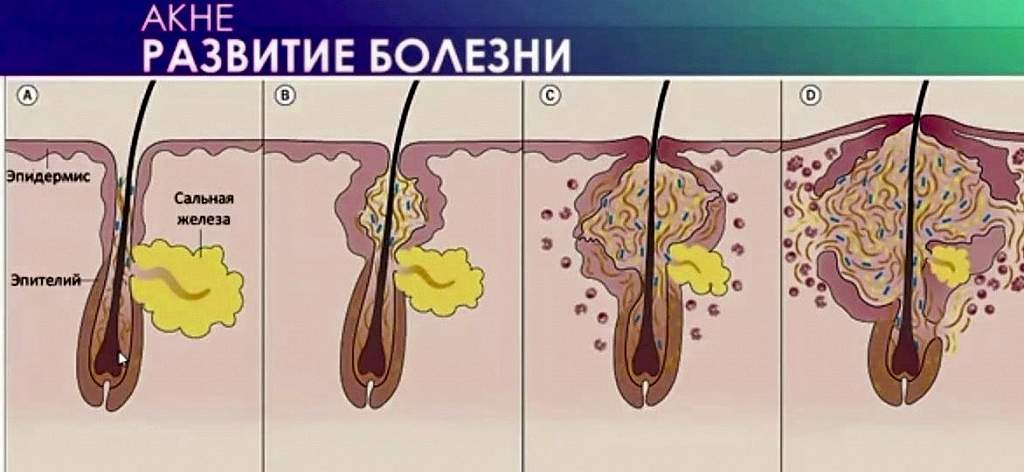 Схема Развития Акне