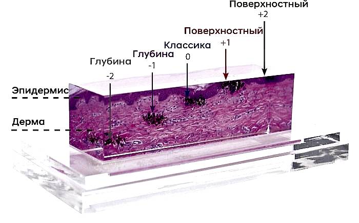 1064-YAG-Clearlift Skin-Graphic-1024x636.jpg 1064-YAG-Clearlift Skin-Graphic-1024x636.jpg