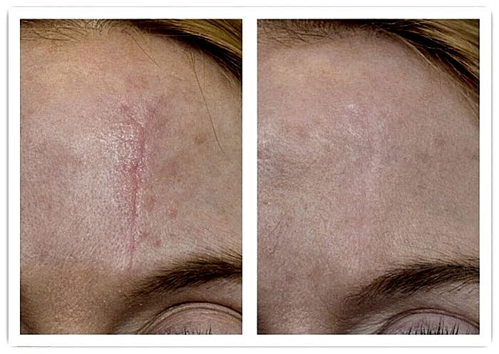 Лазерная шлифовка Laserplanet3-min.jpg