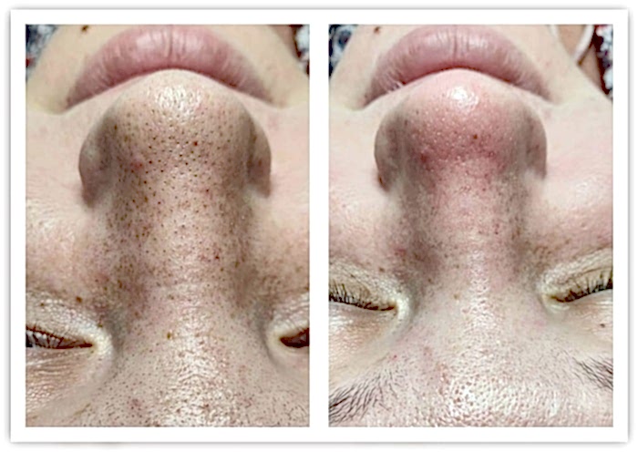 Фото чистки лица до и после 3