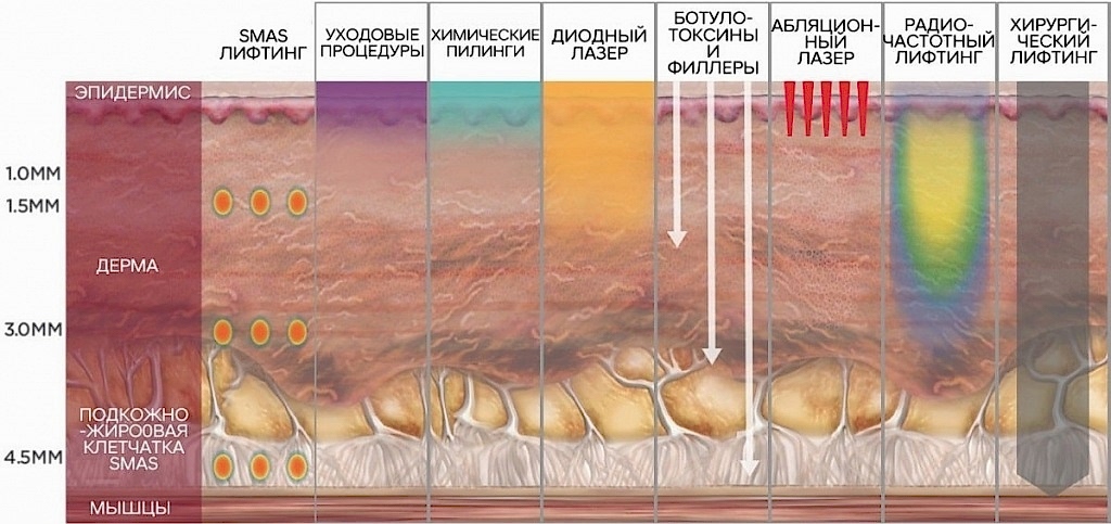 СМАС лифтинг min.jpg
