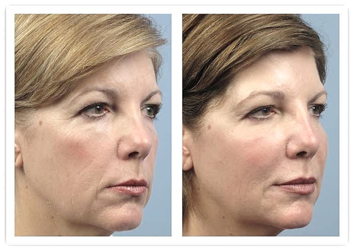 РФ лифтинг до и после Laserplanet3.jpg