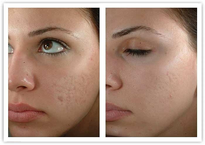 Лазерная шлифовка до после Laserplanet2-min.jpg