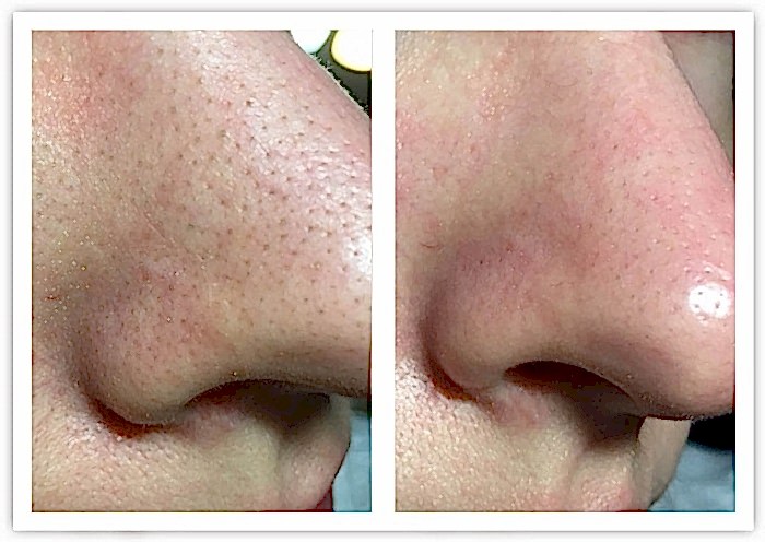 Фото чистки лица до и после 4