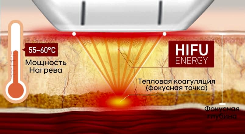 SMAS LASERPLANET.jpg