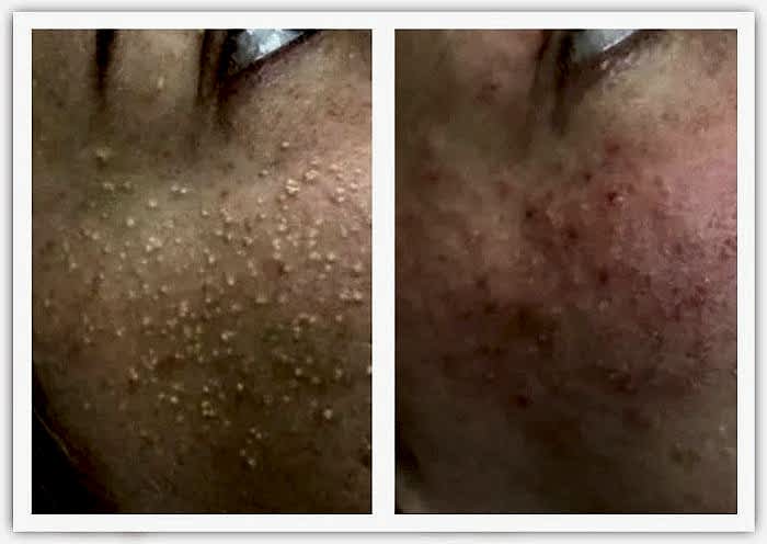 Фото чистки лица до и после 1