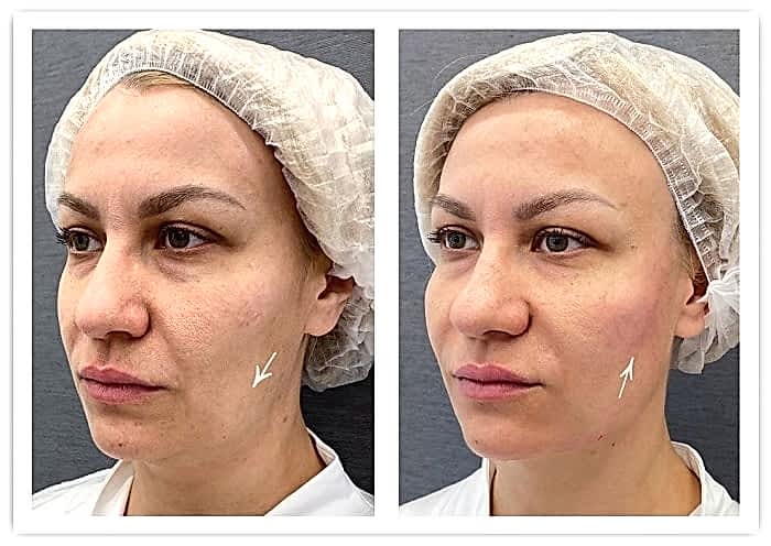 РФ лифтинг до и после Laserplanet.jpg